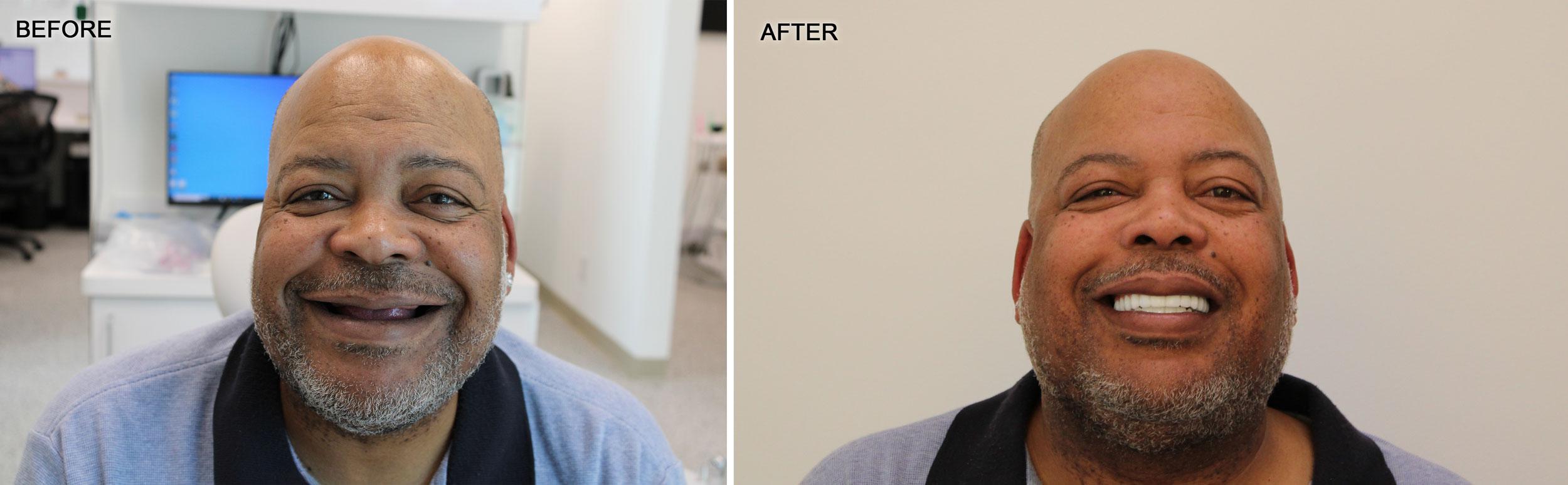 Case showing a patient before and after All-on-4 dental implant placement