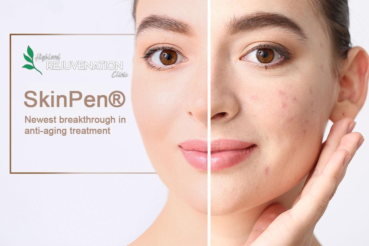SkinPen Microneedling Benefits | Highland Rejuvenation Clinic