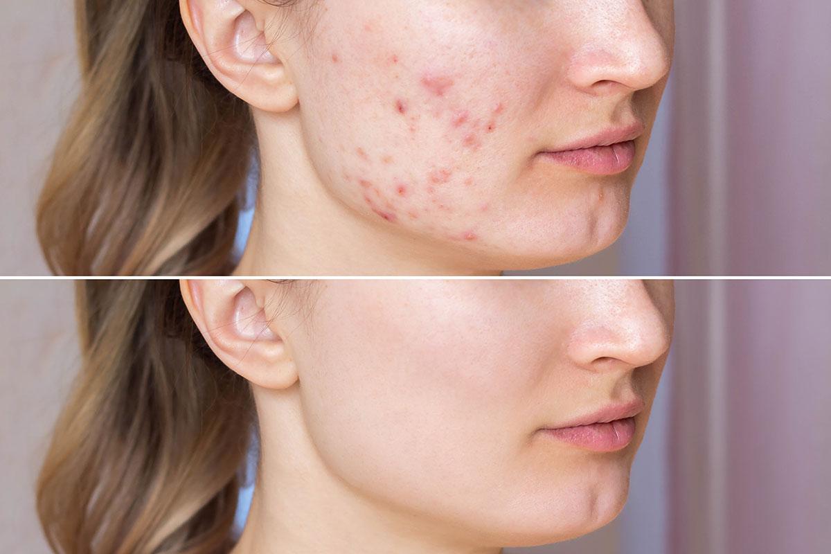 Before and after acne scar treatment with SkinPen